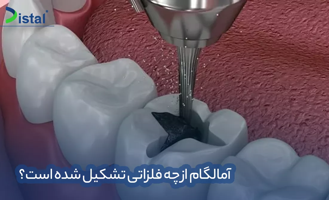 آمالگام از چه فلزاتی تشکیل شده است؟