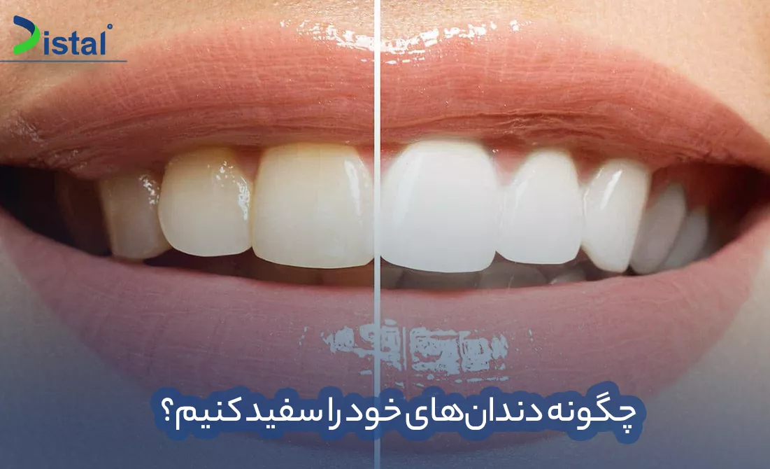 چگونه دندان‌های خود را سفید کنیم؟(سفید کردن دندان)
